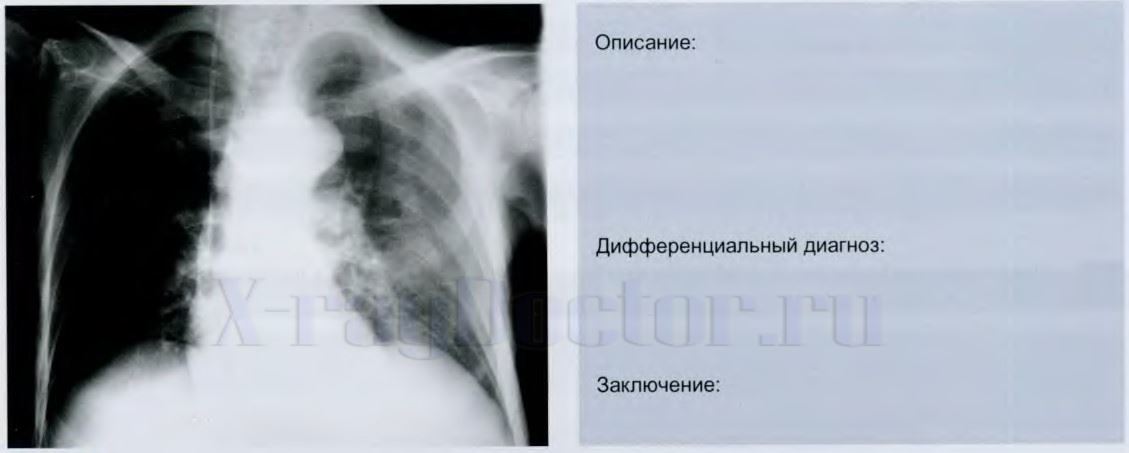 рентгенография легких с планом описания снимка